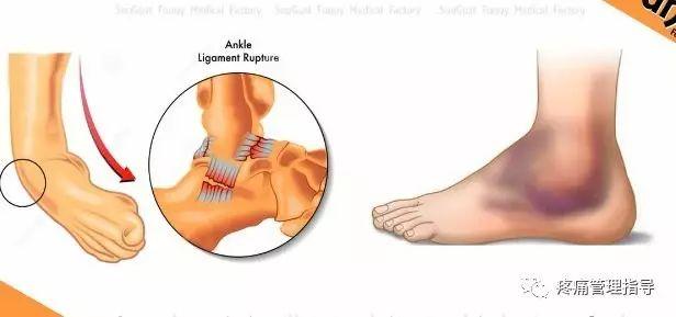nba脚踝扭伤案例 NBA球星脚踝扭伤的处理方法(18)