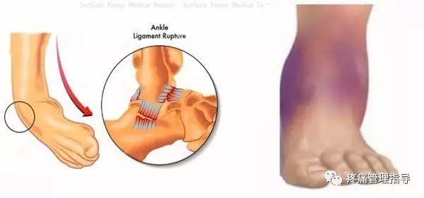 nba脚踝扭伤案例 NBA球星脚踝扭伤的处理方法(19)