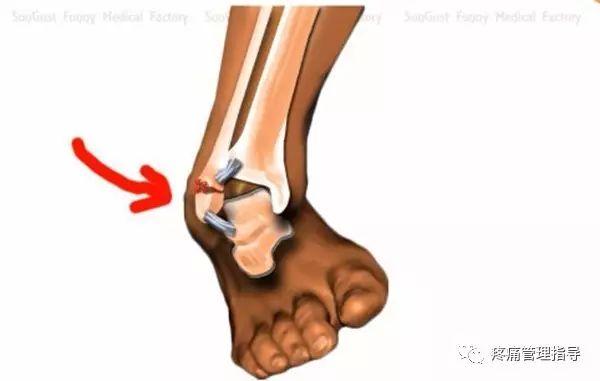 nba脚踝扭伤案例 NBA球星脚踝扭伤的处理方法(21)