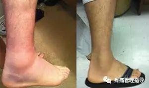 nba脚踝扭伤案例 NBA球星脚踝扭伤的处理方法(42)
