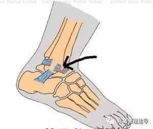 nba脚踝扭伤案例 NBA球星脚踝扭伤的处理方法(50)