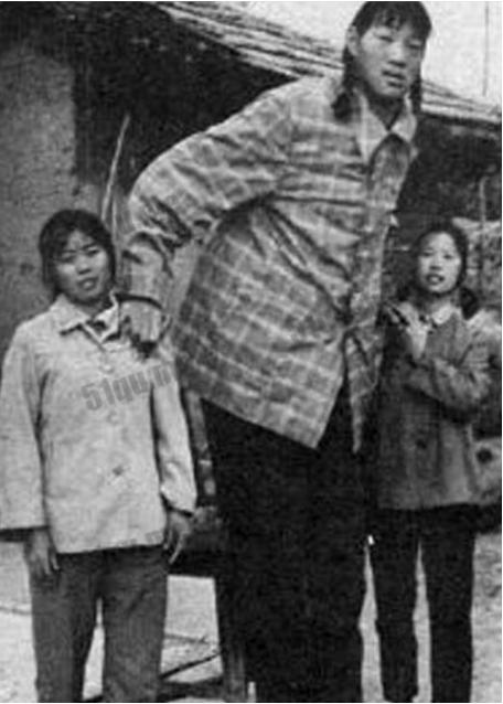 年仅18岁去世的"女巨人", 14岁比姚明高8cm, 至今38年遗体仍在保留(3)