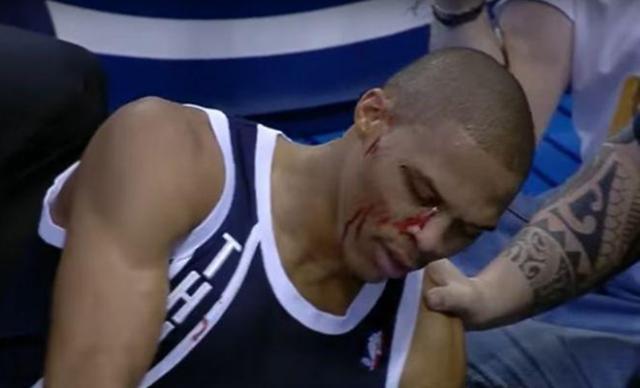 nba哪些球员鼻子受伤 NBA球星浴血奋战(2)
