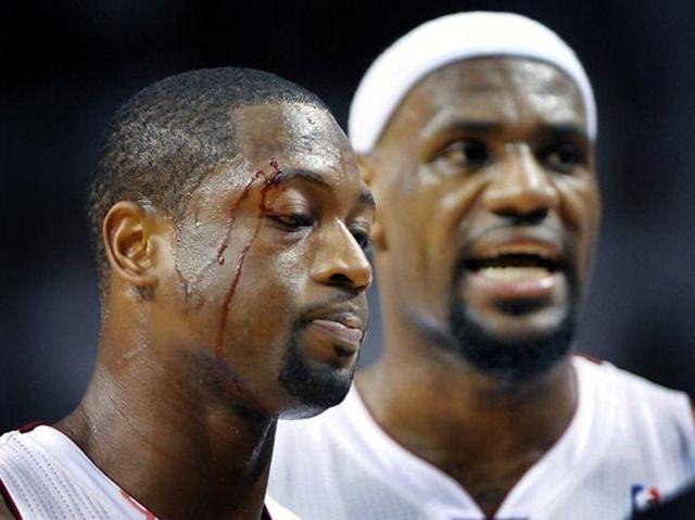 nba哪些球员鼻子受伤 NBA球星浴血奋战(5)