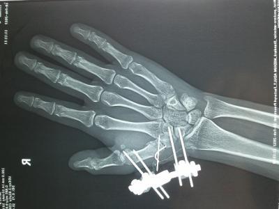 nba球员手掌是不是都做过手术 加索尔手掌骨折手术(3)