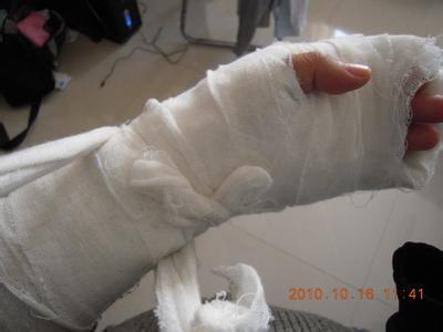 nba球员手掌是不是都做过手术 加索尔手掌骨折手术(4)