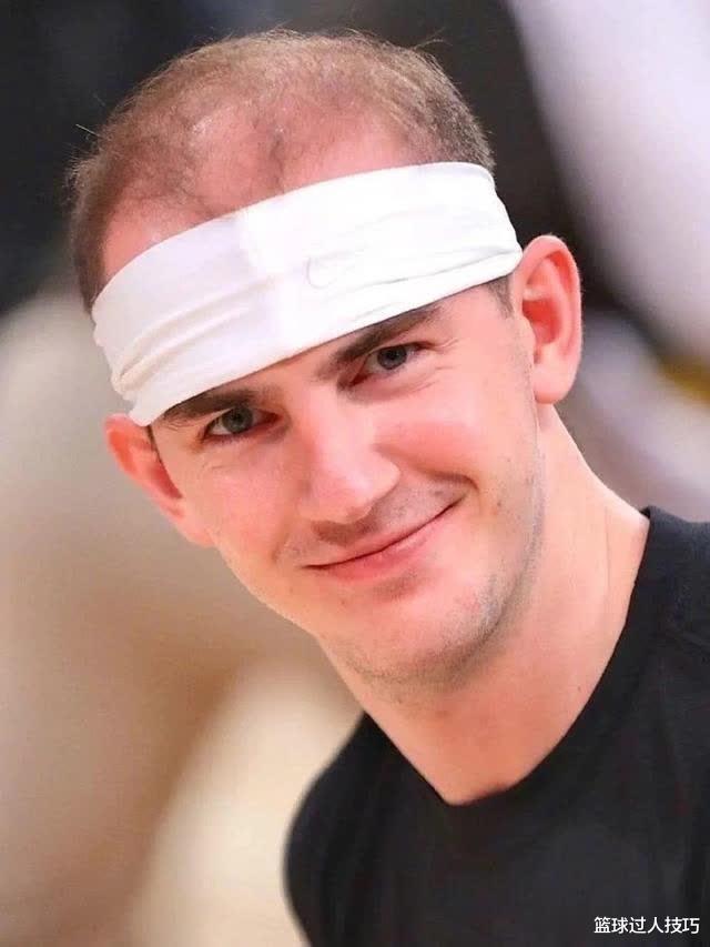 不止程序员秃头，NBA球员也有脱发烦恼！詹姆斯最大手术就是植发(2)