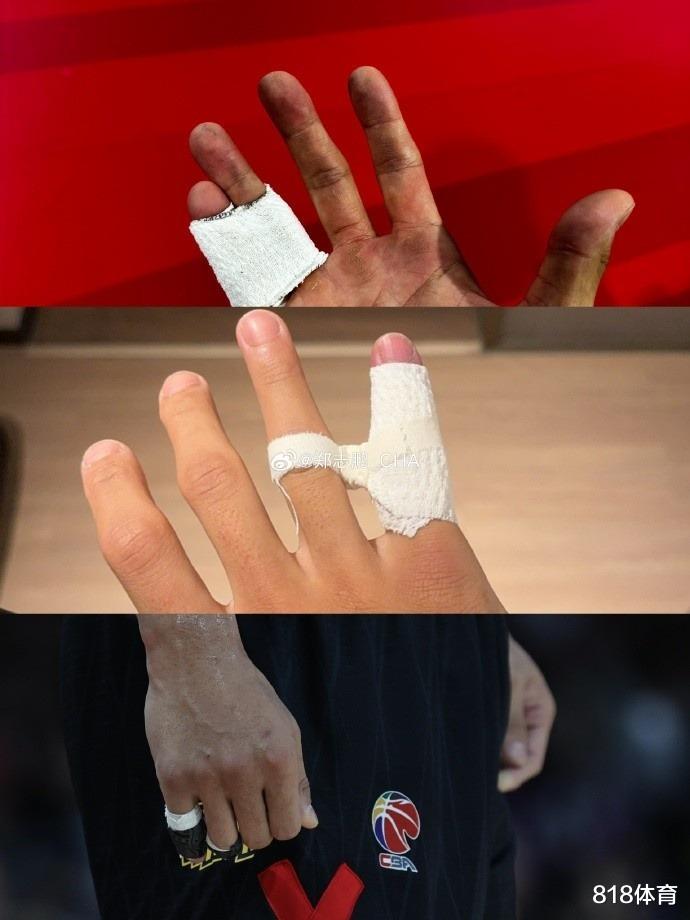 猛士！郑永刚：贺希宁小拇指韧带撕裂+撕脱性骨折，小贺：不影响发挥(3)